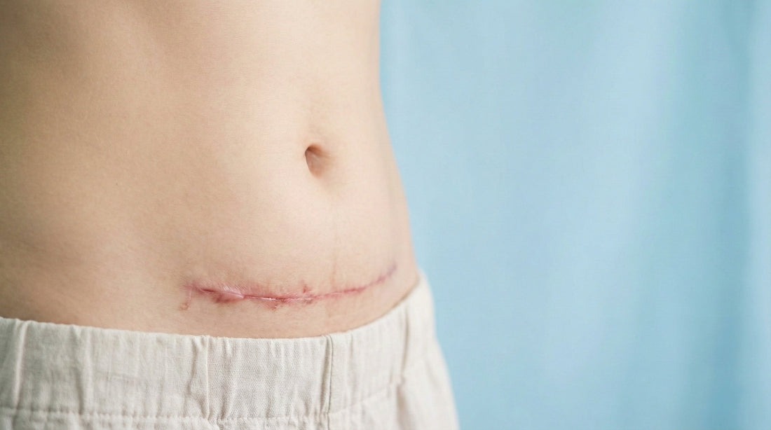 C-Section Wound Care: How Hydrocolloid Bandages Help You Heal Faster