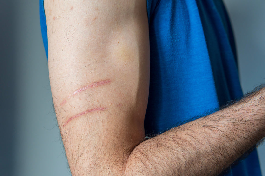 How Hydrocolloid Bandages Help Reduce Scarring: What the Research Says