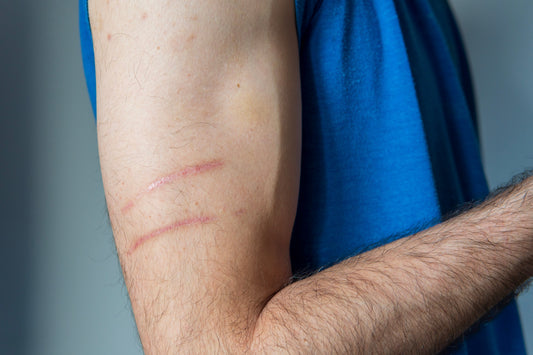 How Hydrocolloid Bandages Help Reduce Scarring: What the Research Says