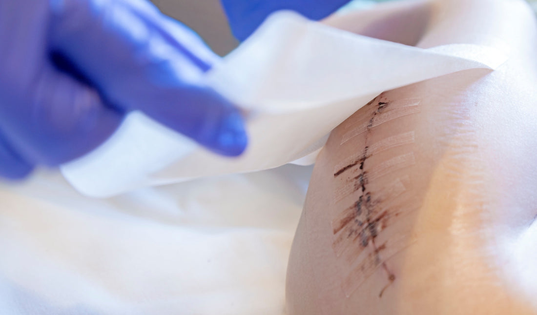 Post-Surgery Healing Made Easier: Why Hydrocolloid Bandages Are a Must-Have After C-Sections and Minor Surgeries