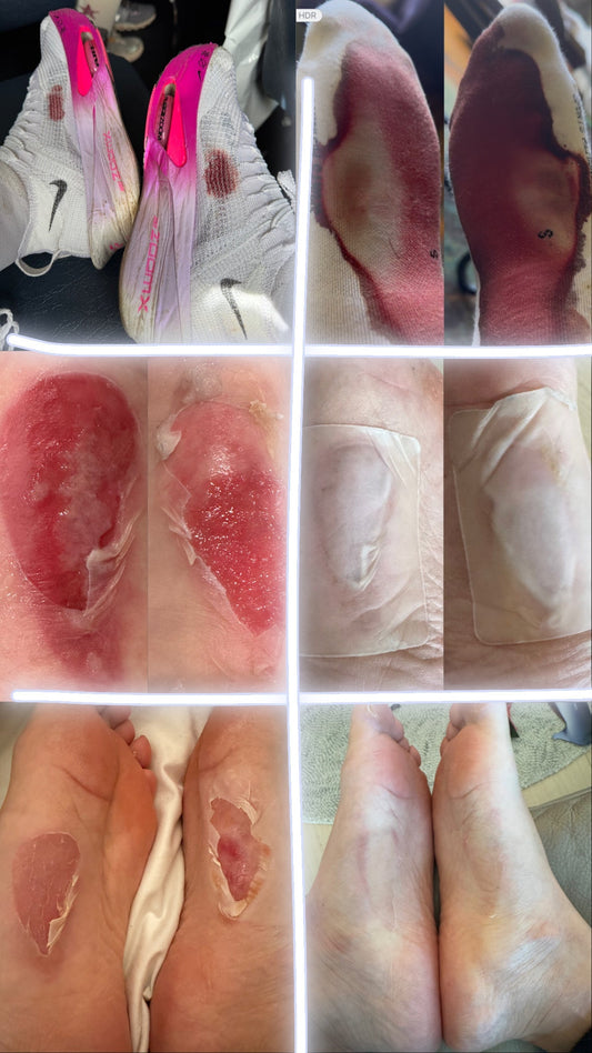 Runner's Blisters: How to Treat, Prevent, and Heal Them Fast with Hydrocolloid Bandages