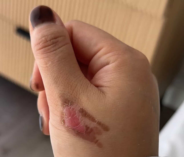 Minor Burns
