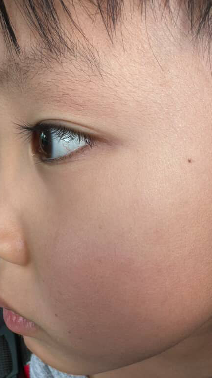 After: healed skin, no visible scar