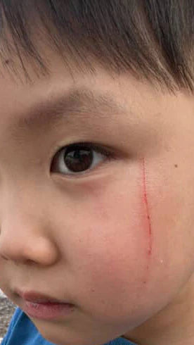 Cuts & Scrapes