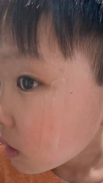 SUPERBAND Cut-to-Size applied along the full length of the scratch