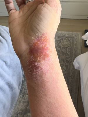 Eczema