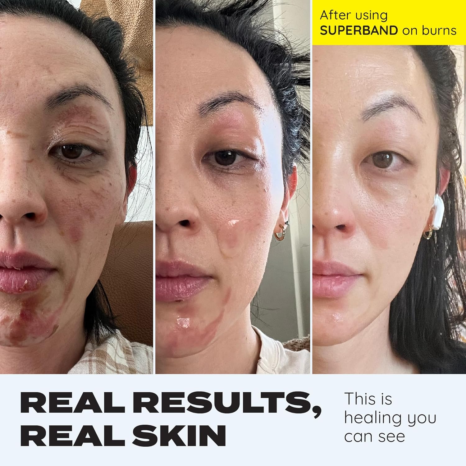 Michelle's burn healing journey — Day 0, Day 3 with SUPERBAND, healed result