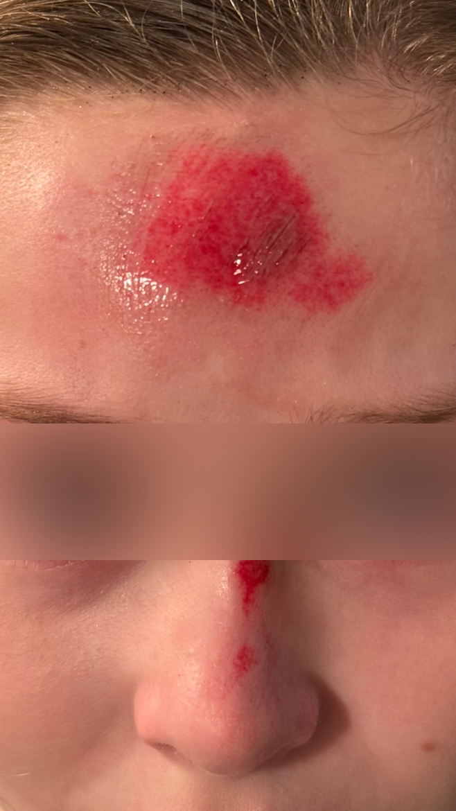 Day 0: Raw forehead abrasion